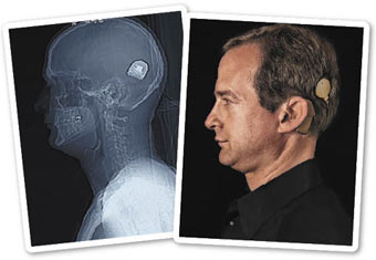 Illustration for article titled Psychic Powers, Cochlear Implants, and My Bionic Ex-Boyfriend